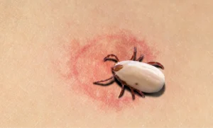 redness from tick bite